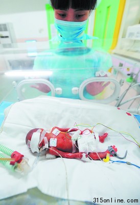 袖珍嬰兒出生體重僅500克捧起他像捧塊豆腐(圖)