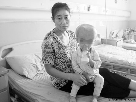 “大頭娃娃”腦外積水頭圍65厘米大腦萎縮(圖)