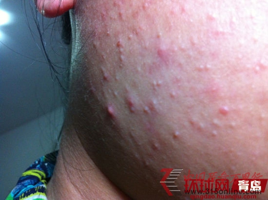 白女士3680元美容療程換來一臉痘痘。